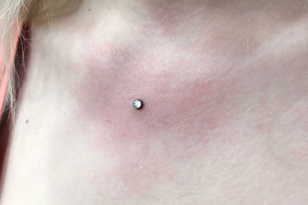 jak dbac o microdermal